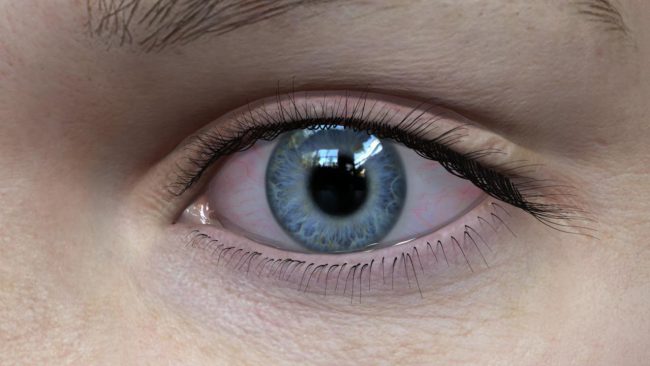 Dry Eye: Cause & Symptoms