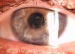 lasik complications