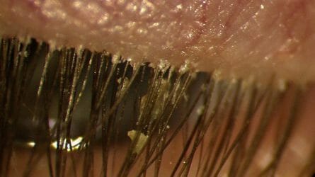 blepharitis